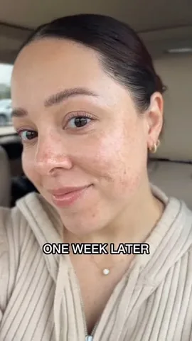 andreamatillano Instagram post about Skincare treatment