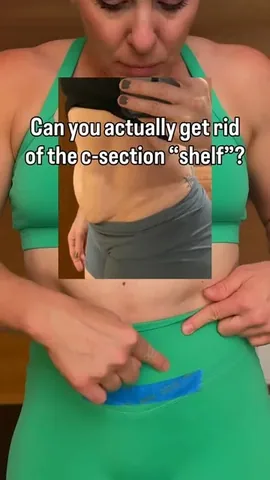 getmomstrong Instagram post about C section scar recovery