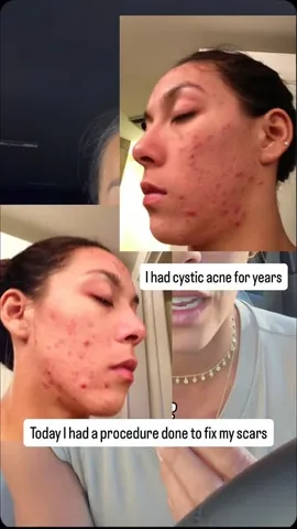 hannaheden_fitness Instagram post about Acne scar treatment experience