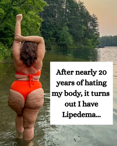hannahlogan21 Instagram post about Lipedema