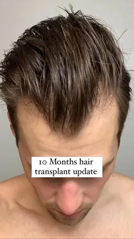 jf_maier Instagram post about Hair transplant progress
