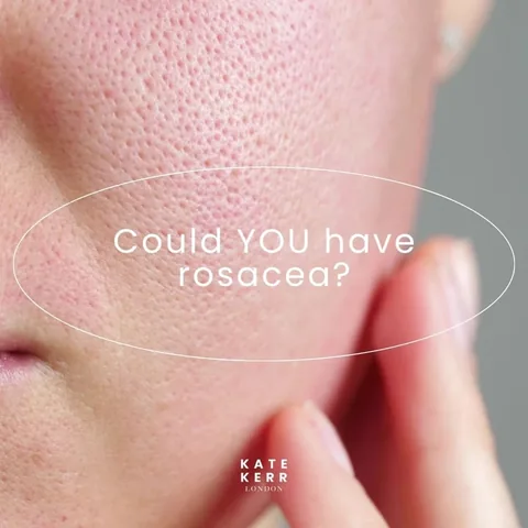 katekerrlondon_facialist Instagram post about Rosacea awareness