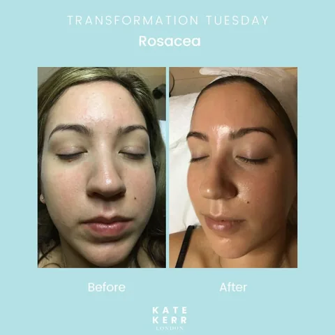 katekerrlondon_facialist Instagram post about Rosacea transformation