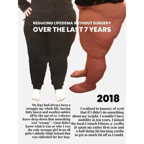 sarah.whitlow_ Instagram post about Lipedema management journey