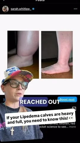 sarah.whitlow_ Instagram post about Lipedema related calf heaviness