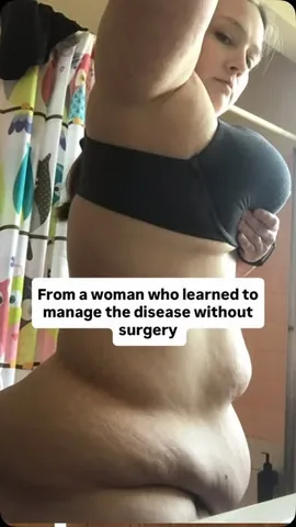 sarah.whitlow_ Instagram post about Lipedema care practices