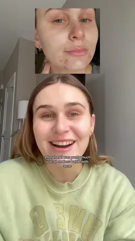skin.and.scrubs Instagram post about Acne spot patches
