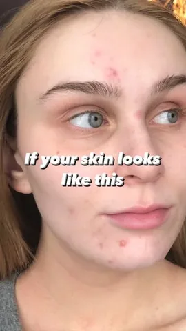 skin.and.scrubs Instagram post about Acne skincare and moisture barrier repair