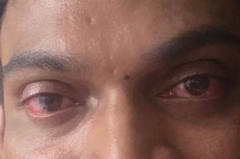 sunitjadhavofficial Instagram post about Eye safety after rain exposure