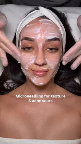 youngcouture_ Instagram post about Microneedling treatment